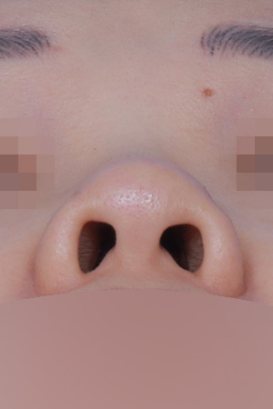 Low bridge and bulbous tip correction — 1 year at Kobijou Rhinoplasty Clinic. Nasal base