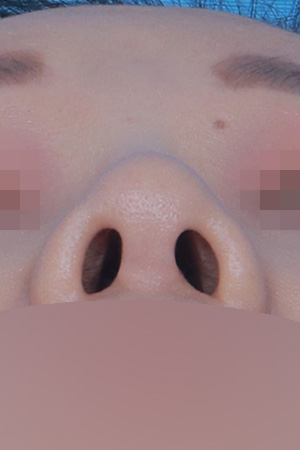 Low bridge and bulbous tip correction — 1 year at Kobijou Rhinoplasty Clinic. Nasal base