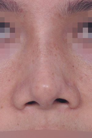 Contracted nose revision with silicone removal — 8 months at Kobijou Rhinoplasty Clinic. Front