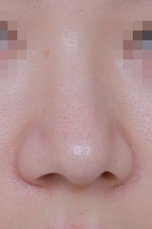 Revision surgery for a deviated and drooping nose — 3 months at Kobijou Rhinoplasty Clinic. Front
