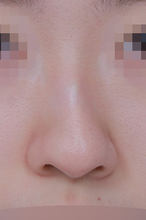 Hump and deviation correction with a nasal root graft — 4 months at Kobijou Rhinoplasty Clinic. Front