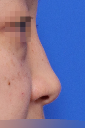 Deviated nose with septal and nasal valve reconstruction — 2 weeks at Kobijou Rhinoplasty Clinic. Side