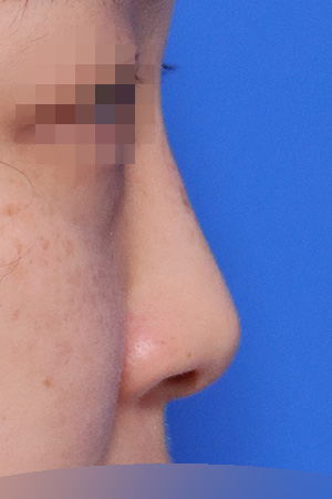 Deviated nose with septal and nasal valve reconstruction — 2 weeks at Kobijou Rhinoplasty Clinic. Side