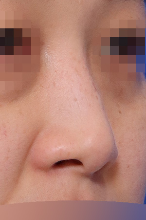 Deviated nose with septal and nasal valve reconstruction — 2 weeks at Kobijou Rhinoplasty Clinic. Oblique