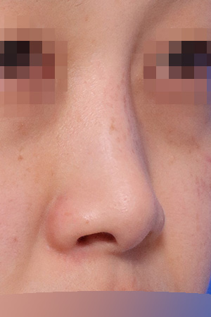 Deviated nose with septal and nasal valve reconstruction — 2 weeks at Kobijou Rhinoplasty Clinic. Oblique
