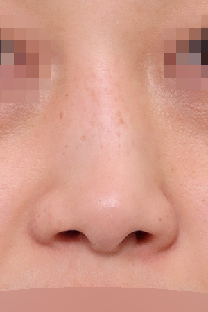 Deviated nose with septal and nasal valve reconstruction — 2 weeks at Kobijou Rhinoplasty Clinic. Front