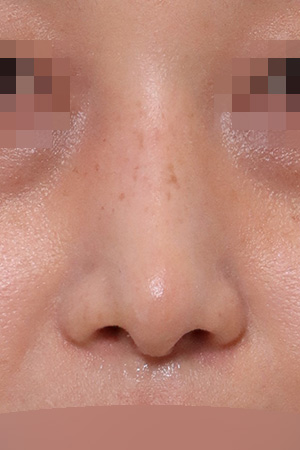 Deviated nose with septal and nasal valve reconstruction — 2 weeks at Kobijou Rhinoplasty Clinic. Front
