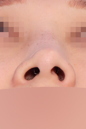 Deviated nose with septal and nasal valve reconstruction — 2 weeks at Kobijou Rhinoplasty Clinic. Nasal base