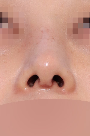 Deviated nose with septal and nasal valve reconstruction — 2 weeks at Kobijou Rhinoplasty Clinic. Nasal base