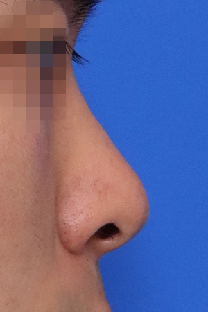 Deviated nose with functional reconstruction — 2 weeks at Kobijou Rhinoplasty Clinic. Side