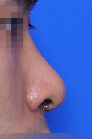 Deviated nose with functional reconstruction — 2 weeks at Kobijou Rhinoplasty Clinic. Side