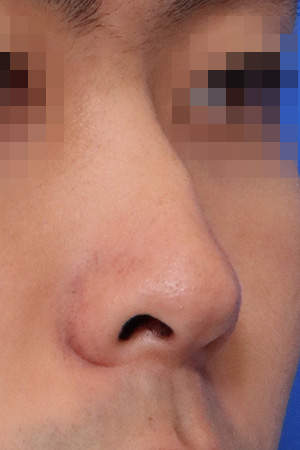 Deviated nose with functional reconstruction — 2 weeks at Kobijou Rhinoplasty Clinic. Oblique