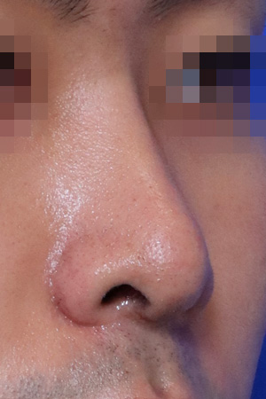 Deviated nose with functional reconstruction — 2 weeks at Kobijou Rhinoplasty Clinic. Oblique