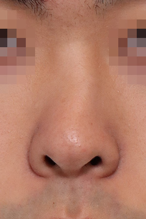 Deviated nose with functional reconstruction — 2 weeks at Kobijou Rhinoplasty Clinic. Front