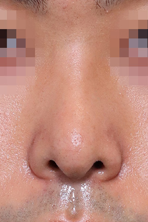 Deviated nose with functional reconstruction — 2 weeks at Kobijou Rhinoplasty Clinic. Front
