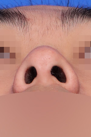 Deviated nose with functional reconstruction — 2 weeks at Kobijou Rhinoplasty Clinic. Nasal base