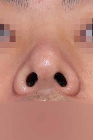 Deviated nose with functional reconstruction — 2 weeks at Kobijou Rhinoplasty Clinic. Nasal base