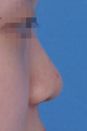 Low bridge and bulbous tip correction with alar reduction — 2 weeks at Kobijou Rhinoplasty Clinic. Side