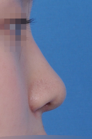 Low bridge and bulbous tip correction with alar reduction — 2 weeks at Kobijou Rhinoplasty Clinic. Side