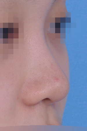 Low bridge and bulbous tip correction with alar reduction — 2 weeks at Kobijou Rhinoplasty Clinic. Oblique