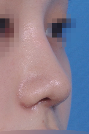 Low bridge and bulbous tip correction with alar reduction — 2 weeks at Kobijou Rhinoplasty Clinic. Oblique