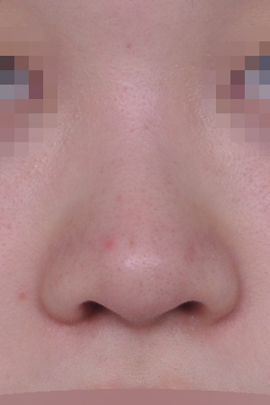 Low bridge and bulbous tip correction with alar reduction — 2 weeks at Kobijou Rhinoplasty Clinic. Front