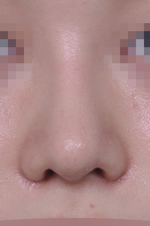 Low bridge and bulbous tip correction with alar reduction — 2 weeks at Kobijou Rhinoplasty Clinic. Front