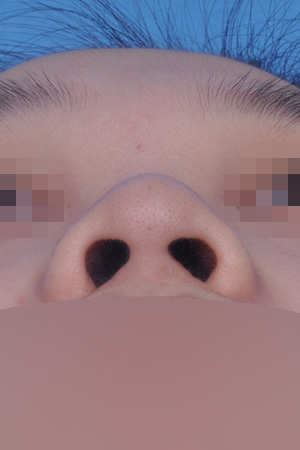 Low bridge and bulbous tip correction with alar reduction — 2 weeks at Kobijou Rhinoplasty Clinic. Nasal base