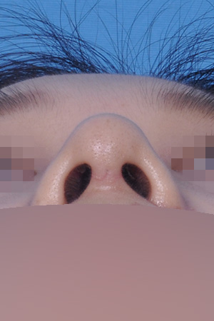 Low bridge and bulbous tip correction with alar reduction — 2 weeks at Kobijou Rhinoplasty Clinic. Nasal base