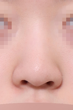 Low bridge and bulbous tip correction — 2 weeks at Kobijou Rhinoplasty Clinic. Front
