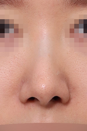 Nasal implant removal and tip revision — 2 weeks at Kobijou Rhinoplasty Clinic. Front