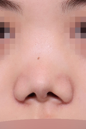 Contracted nose and septal perforation repair — 2 weeks at Kobijou Rhinoplasty Clinic. Front