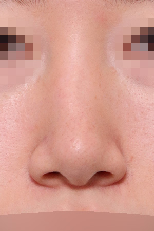 Hump and deviation correction with osteotomy — 2 weeks at Kobijou Rhinoplasty Clinic. Front