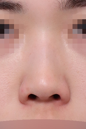 Short nose correction with columellar extension — 2 weeks at Kobijou Rhinoplasty Clinic. Front