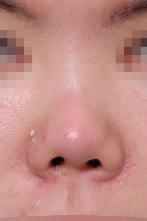 Contracted nose with septal reconstruction — 2 weeks at Kobijou Rhinoplasty Clinic. Front