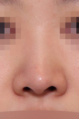 Revision surgery for a deviated and drooping nose — 2 weeks at Kobijou Rhinoplasty Clinic. Front