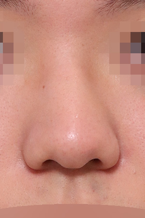 Hump and deviation correction with functional surgery — 2 weeks at Kobijou Rhinoplasty Clinic. Front
