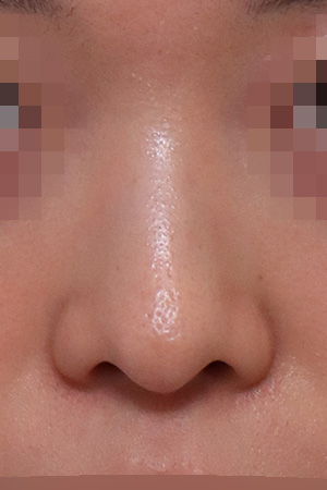 Drooping tip correction with hump preservation — 3 months at Kobijou Rhinoplasty Clinic. Front
