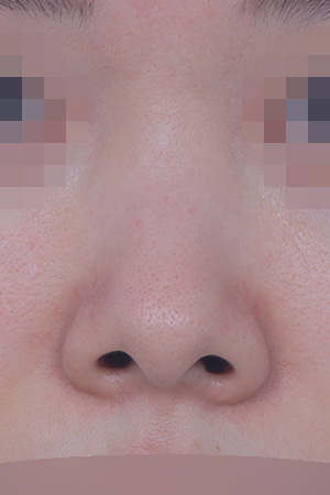 Bulbous tip correction and nostril lowering — 3 months at Kobijou Rhinoplasty Clinic. Front