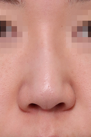 Short nose and drooping tip correction — 2 weeks at Kobijou Rhinoplasty Clinic. Front