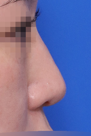 Nasal fracture reconstruction and drooping tip correction — 3 weeks at Kobijou Rhinoplasty Clinic. Side