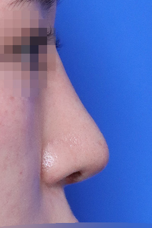 Nasal fracture reconstruction and drooping tip correction — 3 weeks at Kobijou Rhinoplasty Clinic. Side