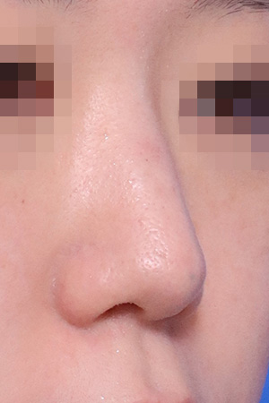 Nasal fracture reconstruction and drooping tip correction — 3 weeks at Kobijou Rhinoplasty Clinic. Oblique