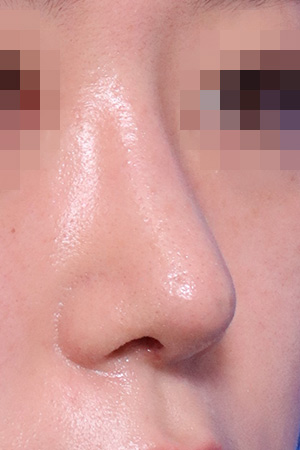 Nasal fracture reconstruction and drooping tip correction — 3 weeks at Kobijou Rhinoplasty Clinic. Oblique
