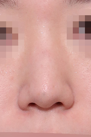 Nasal fracture reconstruction and drooping tip correction — 3 weeks at Kobijou Rhinoplasty Clinic. Front