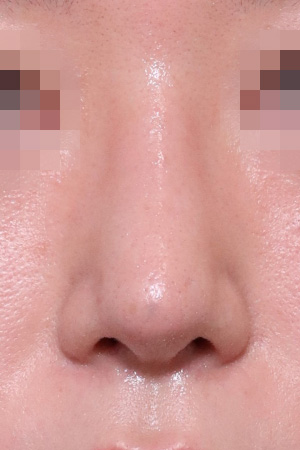 Nasal fracture reconstruction and drooping tip correction — 3 weeks at Kobijou Rhinoplasty Clinic. Front