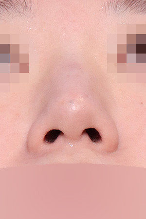 Nasal fracture reconstruction and drooping tip correction — 3 weeks at Kobijou Rhinoplasty Clinic. Nasal base