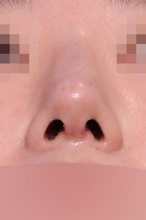 Nasal fracture reconstruction and drooping tip correction — 3 weeks at Kobijou Rhinoplasty Clinic. Nasal base