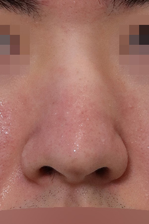 Deviated nose and drooping tip correction — 3 months at Kobijou Rhinoplasty Clinic. Front
