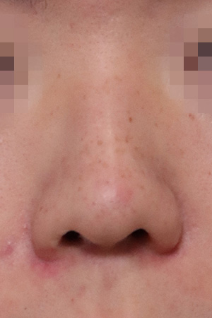 Nasal hump correction — 3 months at Kobijou Rhinoplasty Clinic. Front